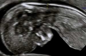 Echographie clarté nucale